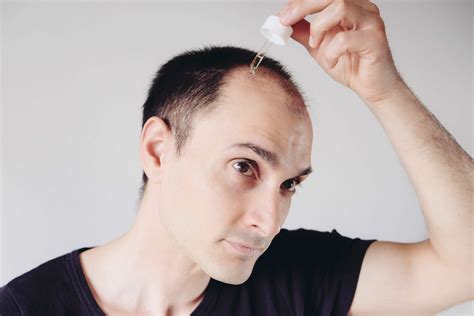 Dlq01 Dermaliqs New Hair Loss Drug Starts Clinical Trials Hairscience