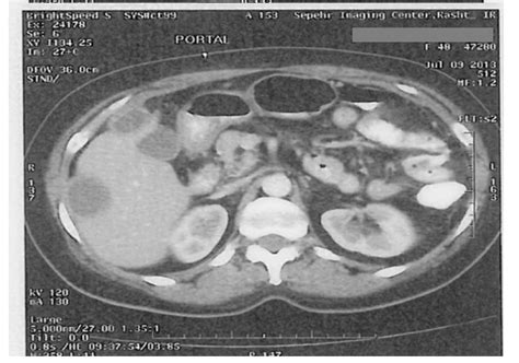 Ct Scan Of The Abdomen Showing Well Defined Hypo Dense Masses In The