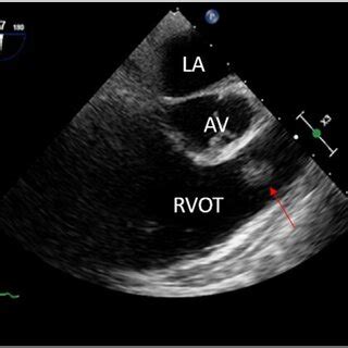Two Dimensional Tee Midesophageal Right Ventricular Inflow Outflow