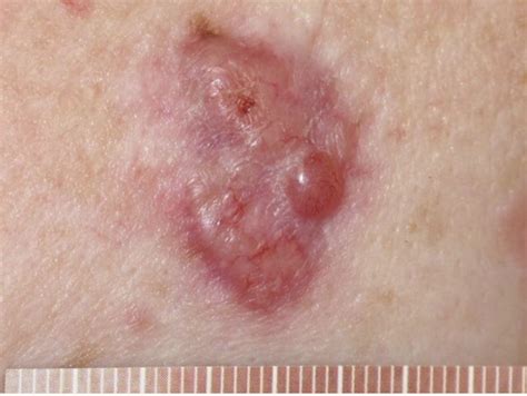 Basal Cell Carcinoma Dermatology Hb