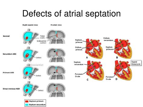 Ppt Congenital Heart Defects Anatomic Consideration Powerpoint