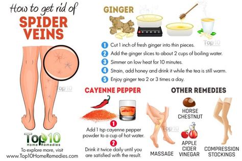 How To Get Rid Of Spider Veins Top 10 Home Remedies
