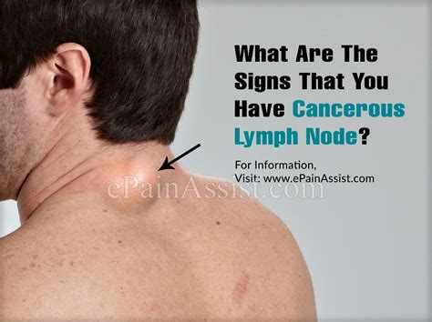 What Are The Signs That You Have Cancerous Lymph Node