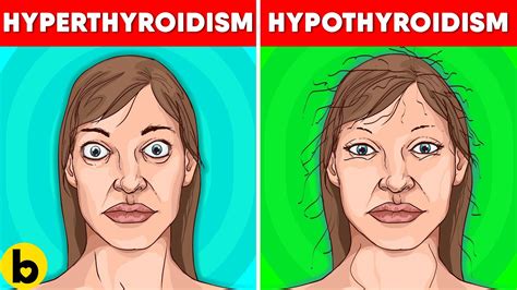 Thyroid Symptoms In Women Signs Causes And Treatment Youtube