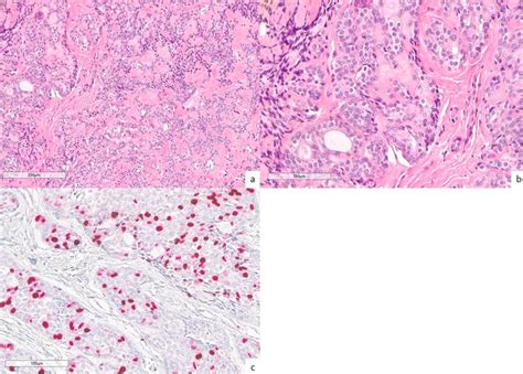 Adenoid Cystic Carcinoma Of Accessory Parotid Gland A Case Report And