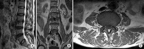 The Lumbar Spine Mri Taken In March 2010 A The Sagittal Plane