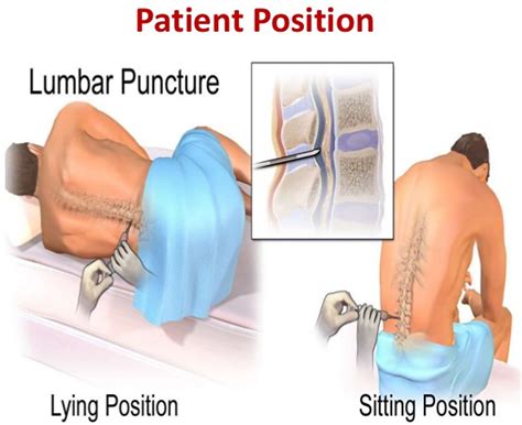 Unlocking The Mystery Can InVision Perform Lumbar Punctures Systran Box