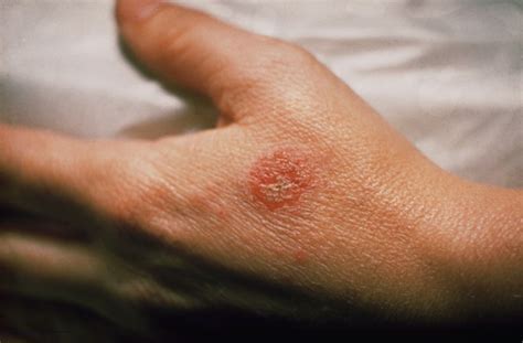 Scientists Home In On Eczema Causing Germs