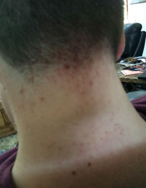 How Do I Get Rid Of Acne On The Back Of My Neck At Hairline