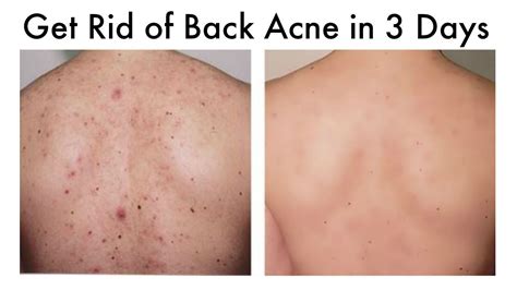 How To Get Rid Of Back Acne At Home In 3 Days Youtube Back Acne