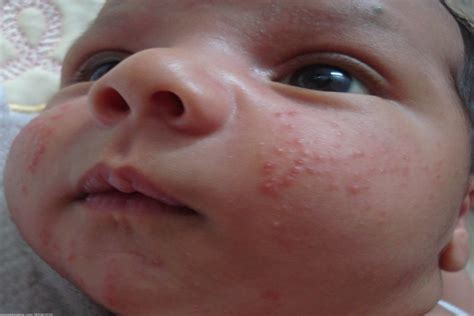 La Piel Del Recién Nacido Y Sus Problemas Dermatológicos