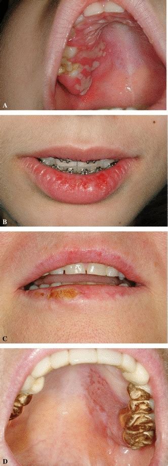 Examples Of Clinical Manifestation Of Herpes Simplex Virus Type 1