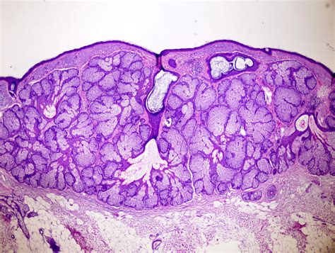 Pathology Outlines Sebaceous Hyperplasia