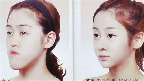 Risky Double Jaw Surgery South Koreas Latest Cosmetic Fad South