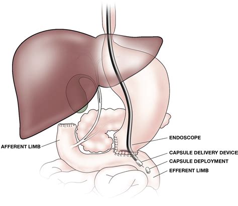 Endoscopic Placement Of The Small Bowel Video Capsule By Using A