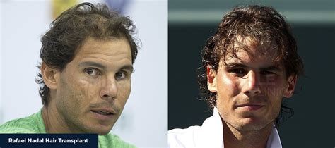 Rafael Nadals Hair Transplant Smile Hair Clinic