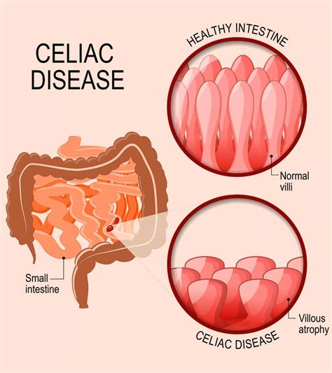 17 Common Signs And Symptoms Of Celiac Disease In Teens