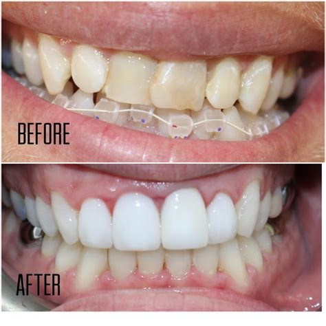 5 Before And After Invisalign Transformations Tooth Doctor