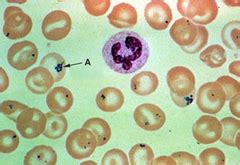 Study flashcards on rbc morphology/inclusions at cram.com. RBC inclusion flashcards | Quizlet