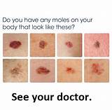 Images of What Doctor To See For Moles
