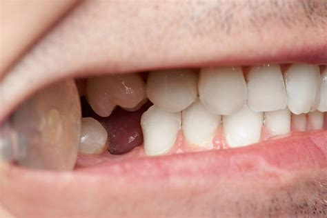 Top 5 Causes Of Tooth Loss In Adults Lives On