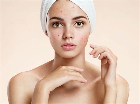 What To Use And How To Take Care Of Skin Affected With Acne