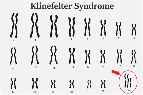 Cos La Sindrome Di Klinefelter Plus Magazine