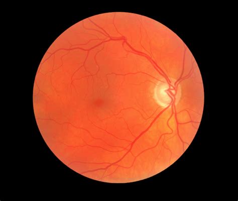 Glaucoma Medical Image Of Fundus Retina Showing Optic Disc Cupping