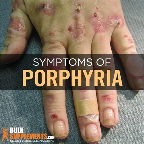 Tablo Read Porphyria Symptoms Causes And Treatments By