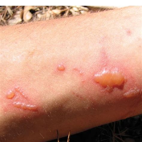 Pdf Phytodermatitis A Brief Review Of Human Skin Reactions Caused By