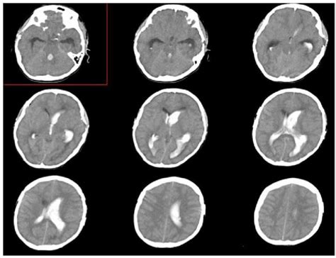Head Ct On Admission Shows Diffuse Intraventricular Hemorrhage Ivh