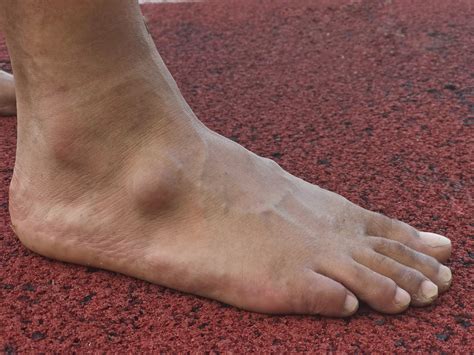 Bump On Foot Ankle And Foot Centers Of Georgia West Cobb