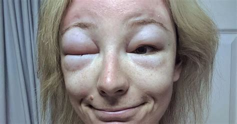 Woman Left Looking Like Swollen Monster After Allergic Reaction To