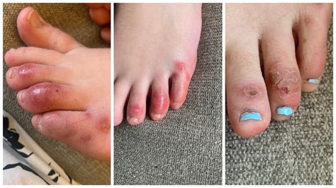‘covid Toes Might Be Newest Coronavirus Symptom Seen Mostly In Kids