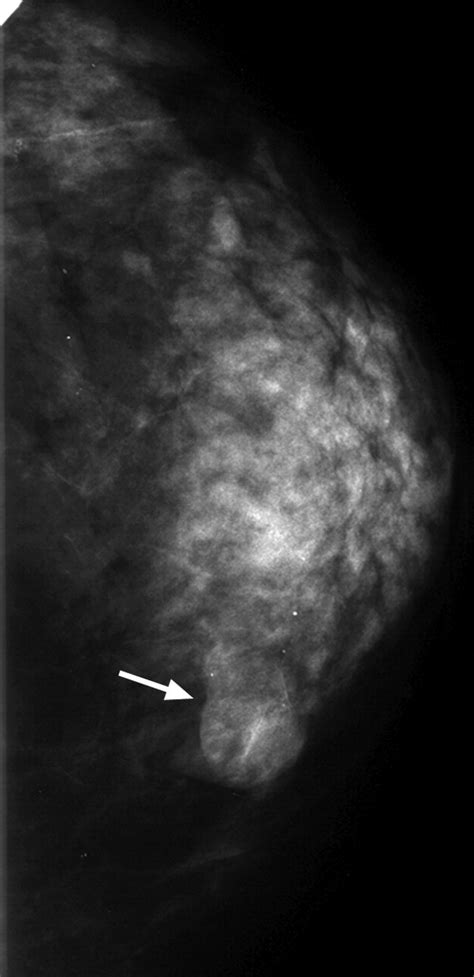 Complex Cystic Breast Masses Diagnostic Approach And Imaging