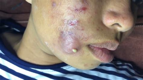 Infected Cystic Acne Removal Videos 2020 Youtube Asteroideapresspoems