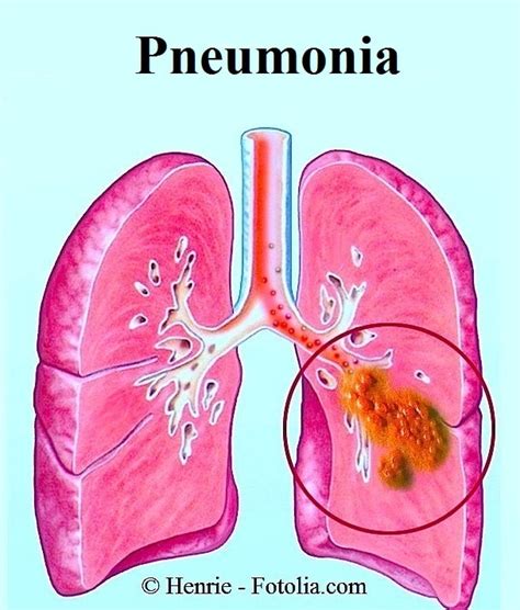 (1992) avaliaram a eficácia e segurança de dois antibióticos no tratamento de pneumonia bacteriana de origem comunitária em adultos. Sintomas de pneumonia viral e tratamento