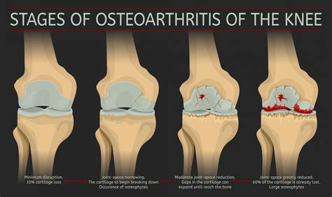 what is osteoarthritis of the knee stages symptoms causes diagnosis images and photos finder