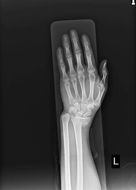 Premium Photo X Ray Left Wrist Joint Fracture With Displacement