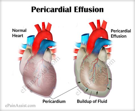 Clinical Manifestations Of Pericarditis And Pericardial Effusions Its Sexiezpix Web Porn