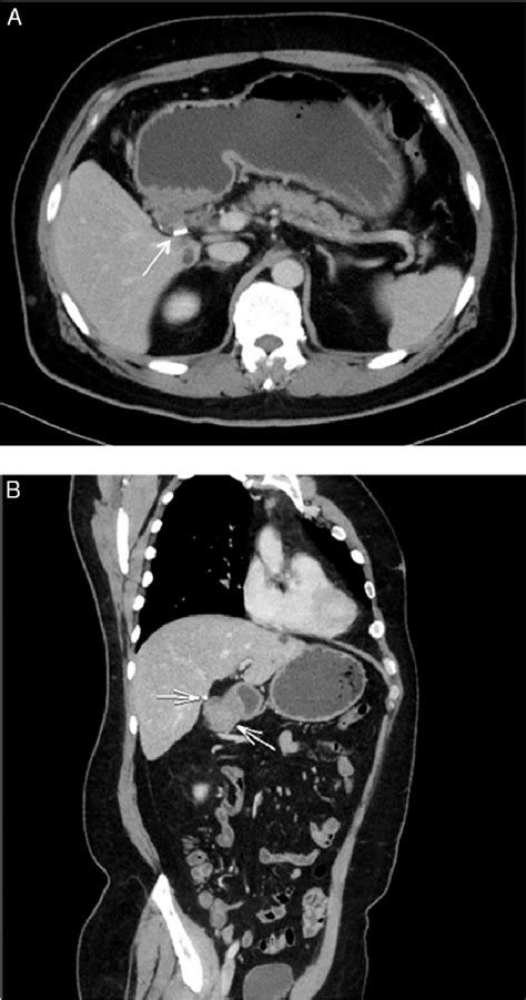 Preoperative Contrast Abdominal Computed Tomography Scan Showing