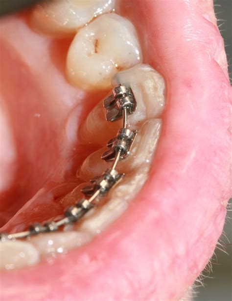 Kieferorthopädie Zahnspangen Selbstligierende Brackets Schienensysteme