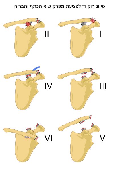 Painful and prominent ac joint. File:ACJ injuries classification.svg