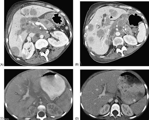 Forty Year Old Woman With Lymphoma A And B Axial Ct Images Show