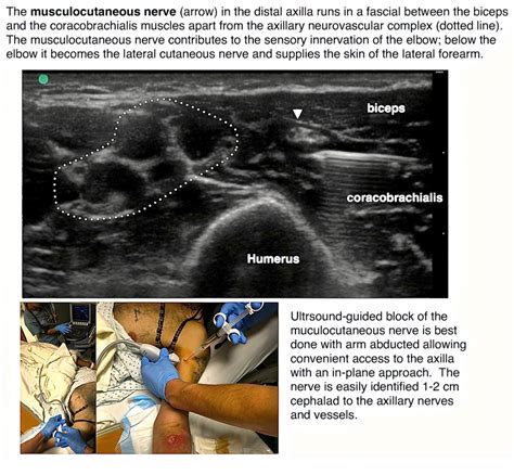 Ultrasound Guided Block For The Medial Forearm — Highland Em Ultrasound