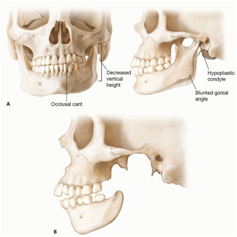 Costochondral Reconstruction For Absent Temporomandibular Joint
