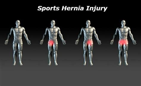 Sports Hernia Groin Muscles