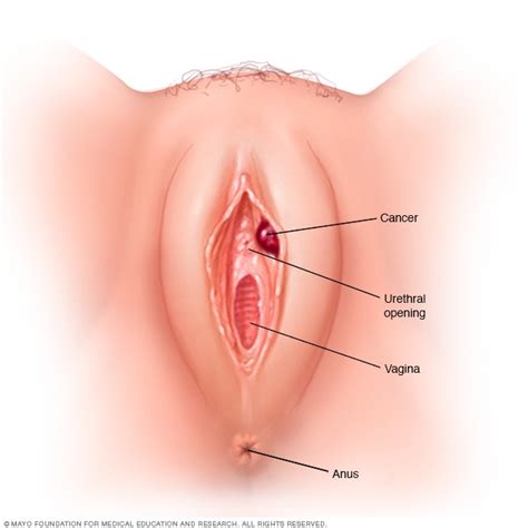 We may include products we think are useful for our readers. Vulvar cancer - Symptoms and causes - Mayo Clinic