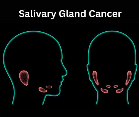 Salivary Gland Cancer Treatment In Pune Dr Ashish Pokharkar