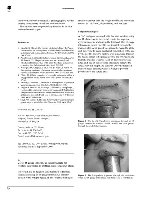 Pdf Use Of 18 Gauge Intravenous Catheter Needle For